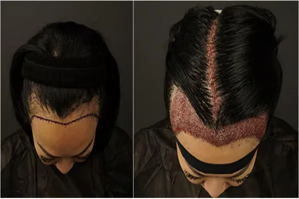 Women Hair Transplant