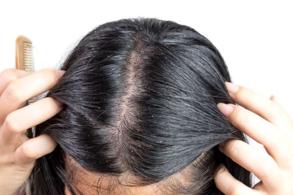 Natural Remedies for Seborrheic Dermatitis 1 Natural Remedies for Seborrheic Dermatitis