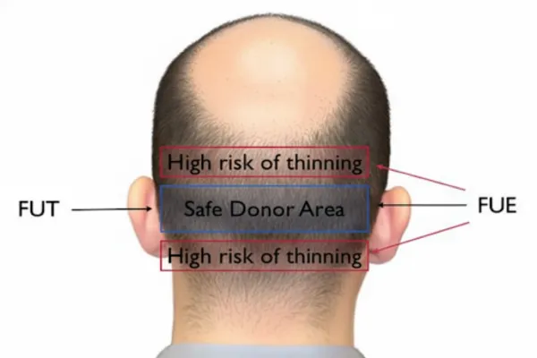 Which Hair Transplant Method Is More Suitable for Someone With a Limited Donor Area?