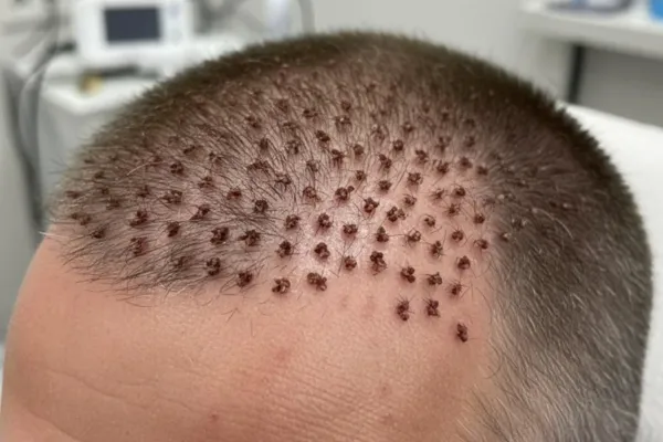 What Is the Best Way to Treat Scabs After a Hair Transplant?