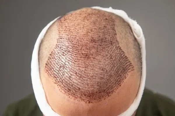 Find the best hair transplant UK cost: Transform your look now!