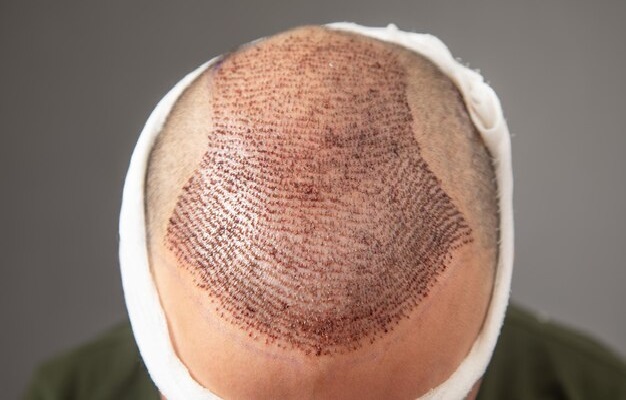 Is a repaired hair graft possible? 6 Is a repaired hair graft possible?
