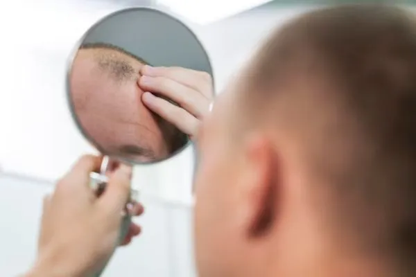 Who is not suitable for a hair transplant?
