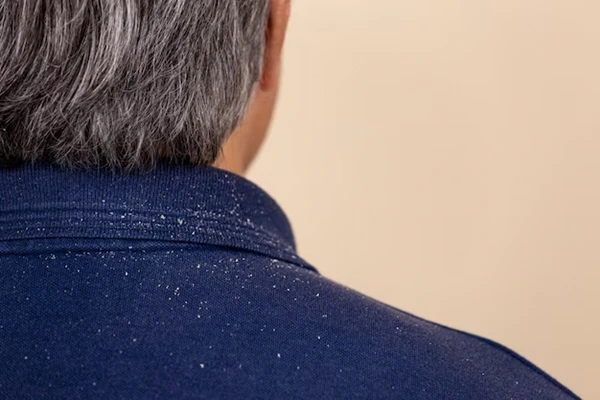 How To Treat Dandruff in Men? 1 How To Treat Dandruff in Men?