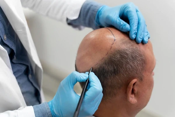 Evolution of the Hair Transplant in Stages 2 Evolution of the Hair Transplant in Stages