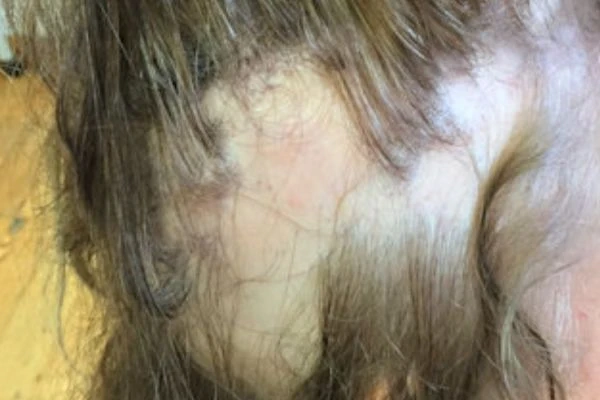 What is Lichen Planus and how can it damage the scalp? 5 What is Lichen Planus and how can it damage the scalp?