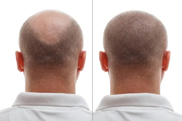 Evolution of hair transplant 1 Evolution of hair transplant