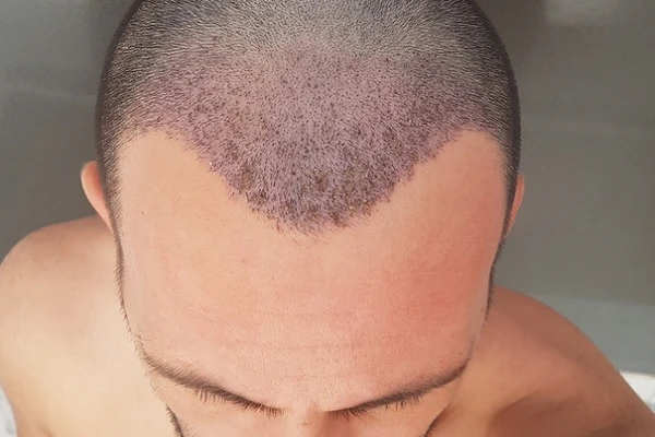 Evolution of the Hair Transplant in Stages 5 Evolution of the Hair Transplant in Stages