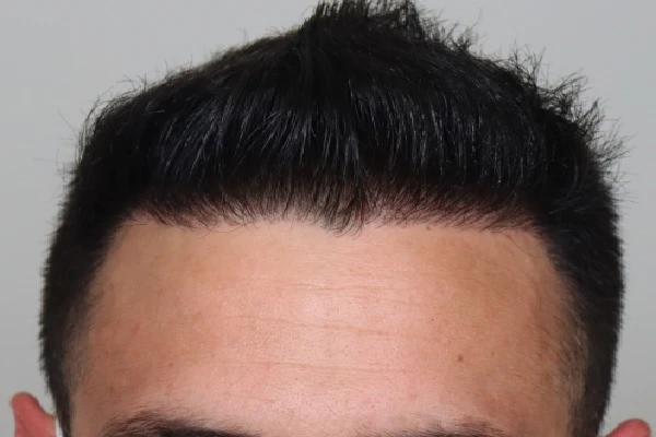 Evolution of the Hair Transplant in Stages 8 Evolution of the Hair Transplant in Stages