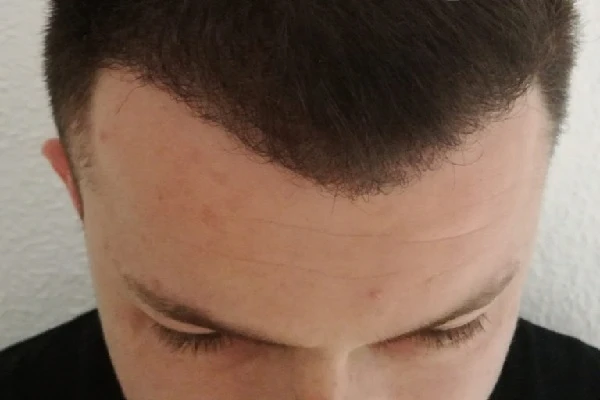Evolution of the Hair Transplant in Stages 7 Evolution of the Hair Transplant in Stages