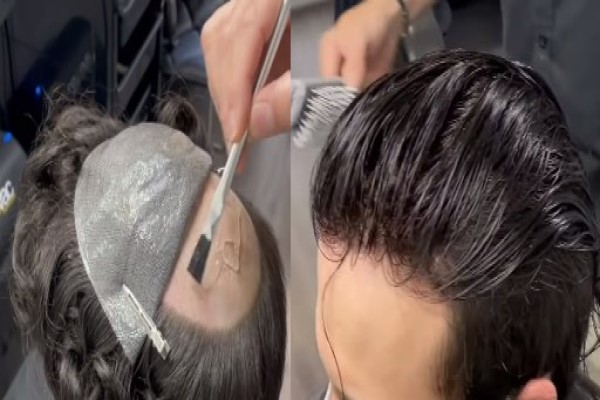 FAS Technical Hair Prosthesis 1 FAS Technical Hair Prosthesis