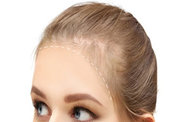 Frontal Fibrosing Alopecia: What Are Its Causes? 2 Frontal Fibrosing Alopecia: What Are Its Causes?