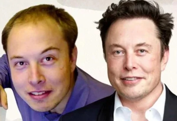 Famous people with hair transplant 8 Famous people with hair transplant
