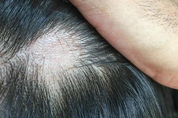 Hair Follicle Structure and its associated Diseases 6 Hair Follicle Structure and its associated Diseases
