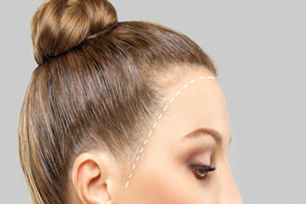Frontal Fibrosing Alopecia: What Are Its Causes? 1 Frontal Fibrosing Alopecia: What Are Its Causes?