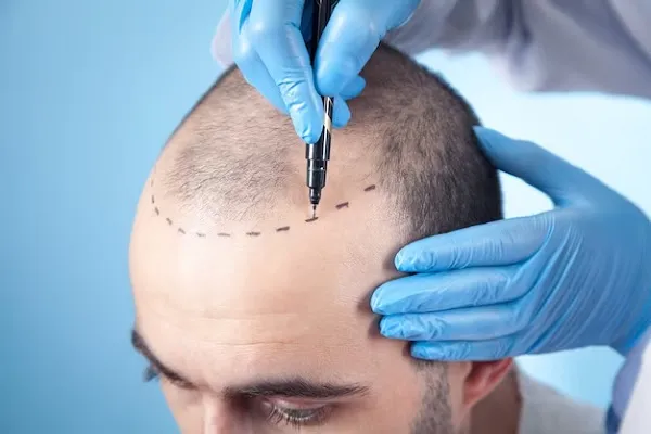 How does hair grow after hair transplant? 2 How does hair grow after hair transplant?