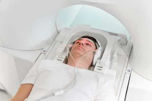 Can Radiotherapy Cause Hair Loss? Is It Permanent? 1 Can Radiotherapy Cause Hair Loss? Is It Permanent?