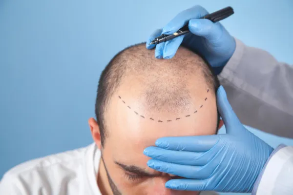 How Surgeons Design a Natural Hairline: Temple Points, Angles, and Face Balance