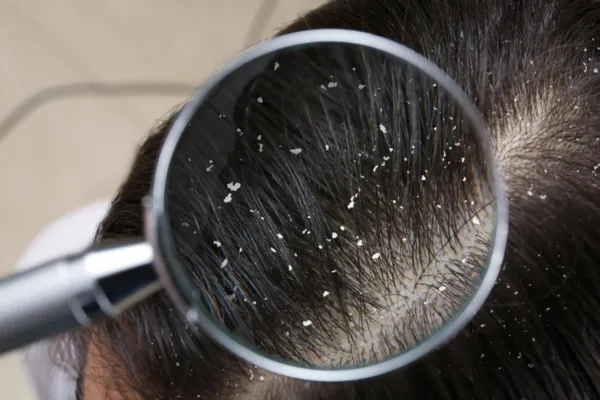 How Severe Dandruff Can Impact Hair Follicles: A Deep Dive