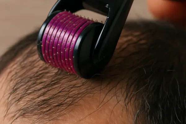 Microneedling at Home Does It Boost Growth or Just Irritate the Scalp 1 Microneedling at Home Does It Boost Growth or Just Irritate the Scalp