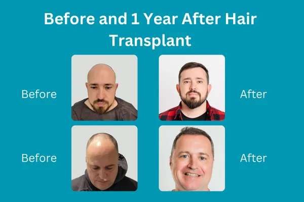What Happens One Year After a Hair Transplant? 2 What Happens One Year After a Hair Transplant?