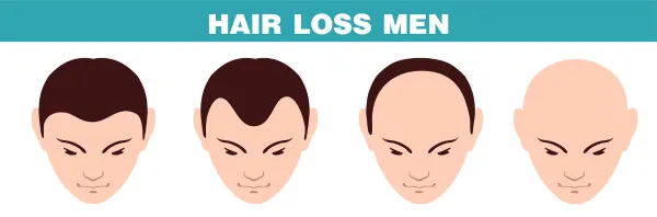 Key Differences Between Male and Female Hair Transplants