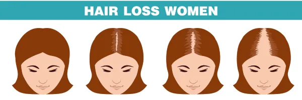 Key Differences Between Male and Female Hair Transplants