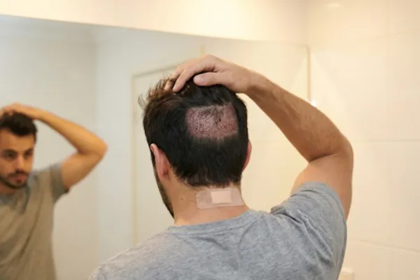 Hair Transplant Scarring and Hair Growth on Scars: What You Need to Know