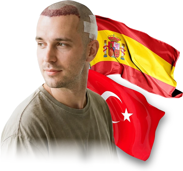 Hair-Transplant-in-Istanbul-and