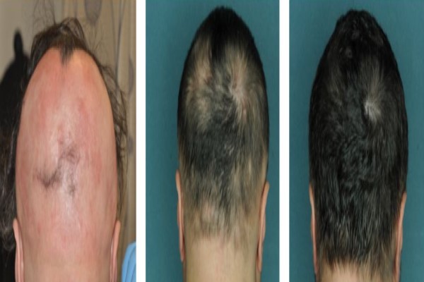 Jak Inhibitors for Alopecia Areata