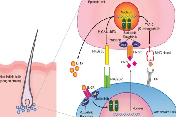 Jak Inhibitors for Alopecia Areata
