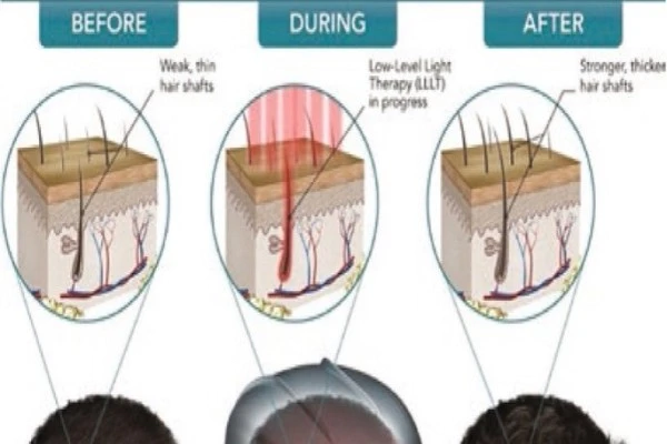 Low Power Laser In Trichology