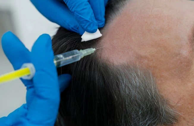 Why doesn’t the grafted hair fall out? 3 Why doesn’t the grafted hair fall out?