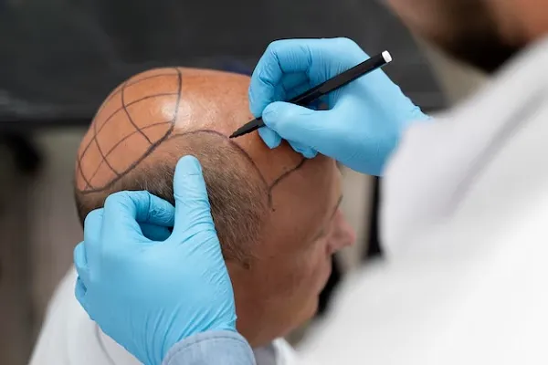 FAQs about hair transplant: All you need to know