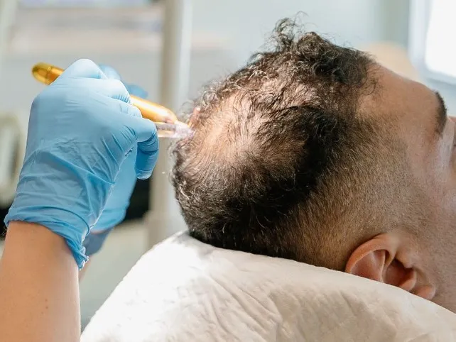 Who is not suitable for a hair transplant?