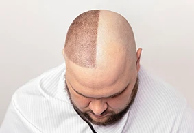 FUE Hair Transplant
