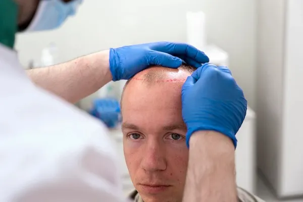 Turkey hair transplant: At the forefront of the world
