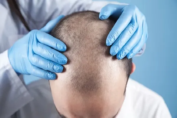 14 things to avoid after a hair transplant