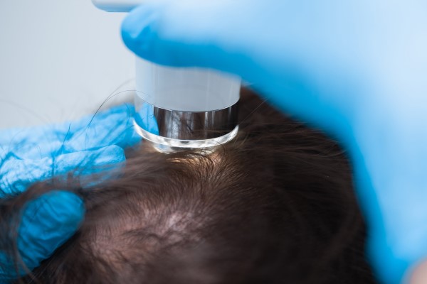 Trichoscopy For Diagnosis of Alopecia 1 Trichoscopy For Diagnosis of Alopecia