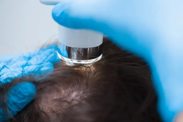 Find the best hair transplant UK cost: Transform your look now! 6 Find the best hair transplant UK cost: Transform your look now!