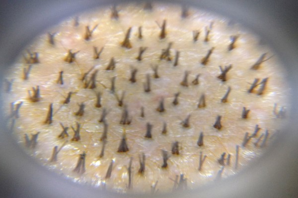 Trichoscopy For Diagnosis of Alopecia 2 Trichoscopy For Diagnosis of Alopecia