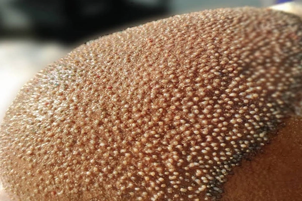 Trypophobia Due to Hair Transplant: Why Does It Occur? 1 Trypophobia Due to Hair Transplant: Why Does It Occur?
