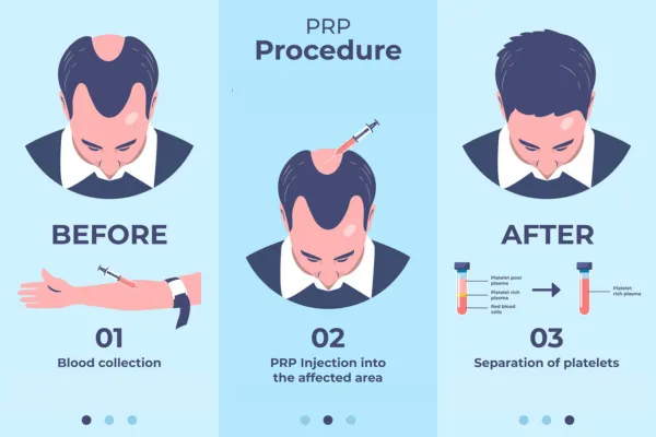 Stem Cell Hair Transplants Explained: What You Need to Know