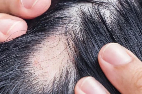 What is Lichen Planus and how can it damage the scalp? 3 What is Lichen Planus and how can it damage the scalp?