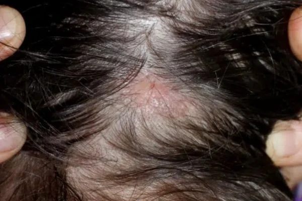 What is Lichen Planus and how can it damage the scalp? 2 What is Lichen Planus and how can it damage the scalp?