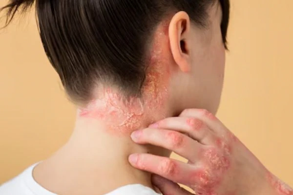 Psoriasis: Symptoms, Causes, and Treatments 2 Psoriasis: Symptoms, Causes, and Treatments