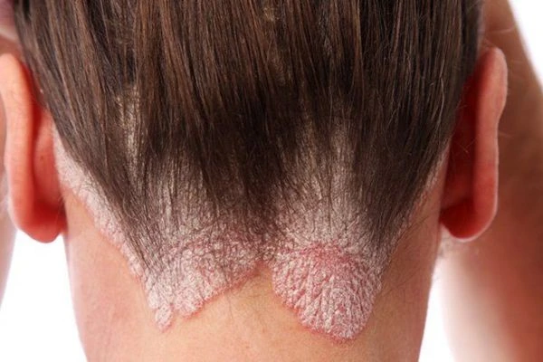 Psoriasis: Symptoms, Causes, and Treatments 4 Psoriasis: Symptoms, Causes, and Treatments