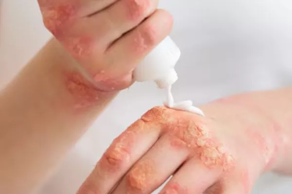 What is Seborrheic Dermatitis? DIY treatments 4 What is Seborrheic Dermatitis? DIY treatments