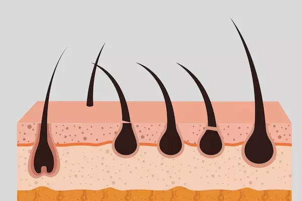 Body Hair Transplant: What is it about?