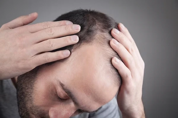 Treatments for alopecia areata 1 Treatments for alopecia areata